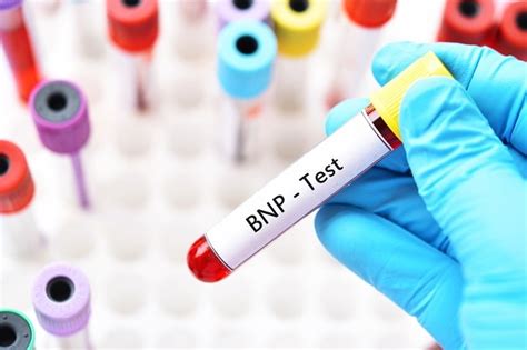 nt pro bnp blood test bottle|what is a dangerous bnp level.